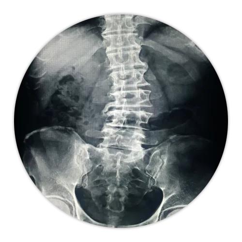 Chiropractic Canonsburg And McMurray PA Scoliosis X-ray Chiropractic Canonsburg And McMurray PA Scoliosis X-ray